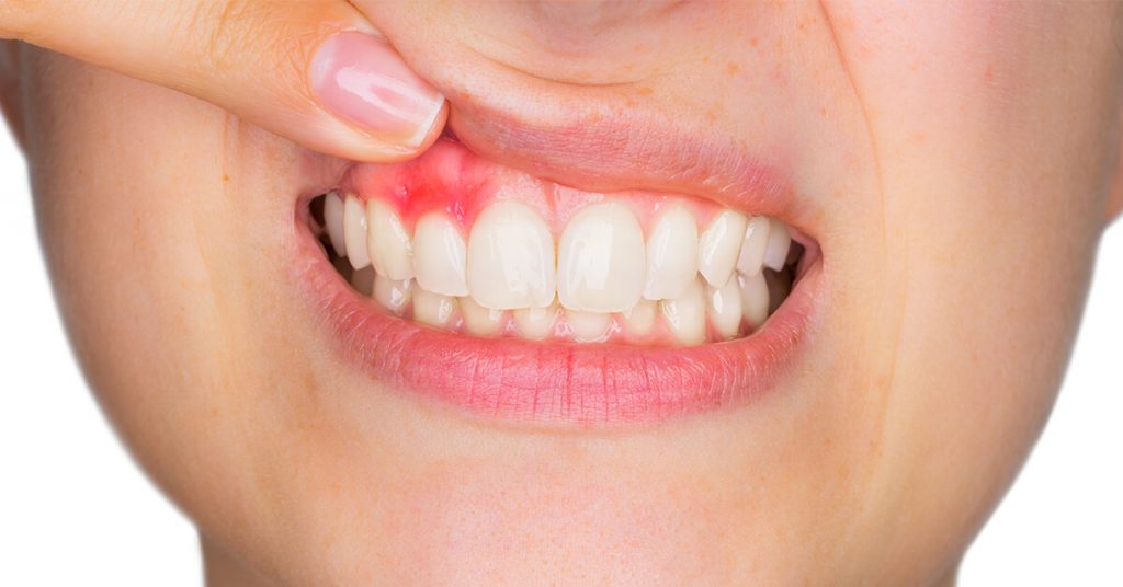 clinica dental garcia rocamora san juan de alicante gingivitis 