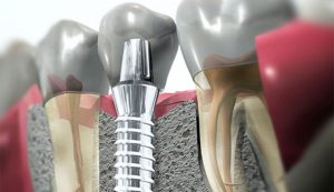 oferta implantes dentales clinica dental san juan alicante