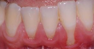 encias retracción clinica dental san juan alicante