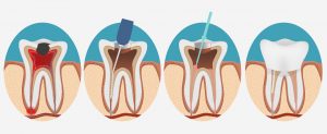 endodoncia clinica dental san juan alicante