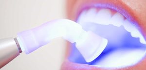 ozonoterapia-dental