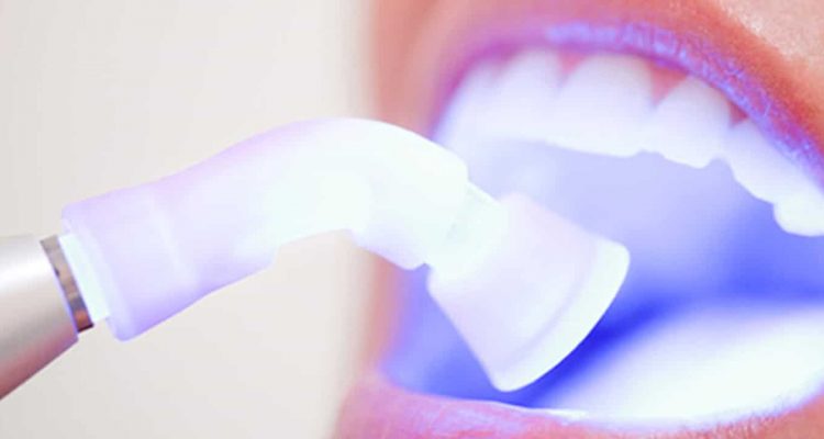 ozonoterapia-dental