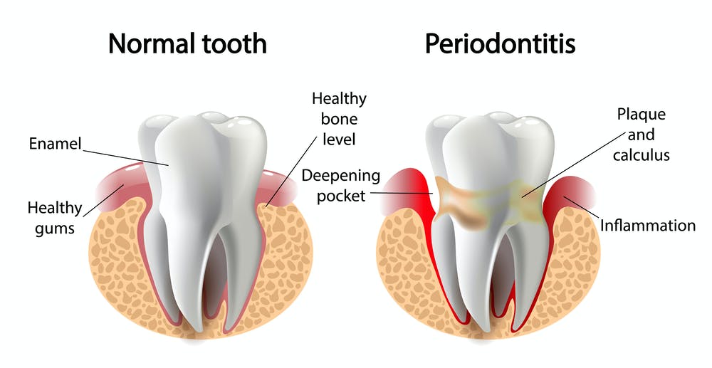 fases_periodontitis clinica dental san juan alicante