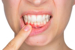fases_periodontitis clinica dental san juan alicante