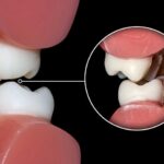 BRUXISMO: QUÉ ES, SÍNTOMAS Y TRATAMIENTO