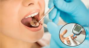 LA DIABETES Y SU RELACIÓN CON LA SALUD ORAL