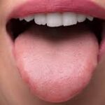 LA LEUCOPLASIA ORAL Y SU IMPLICACIÓN COMO LESIÓN PRECANCEROSA