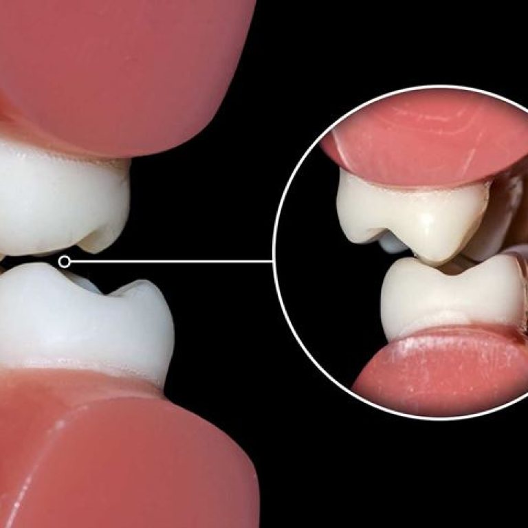 BRUXISMO: QUÉ ES, SÍNTOMAS Y TRATAMIENTO