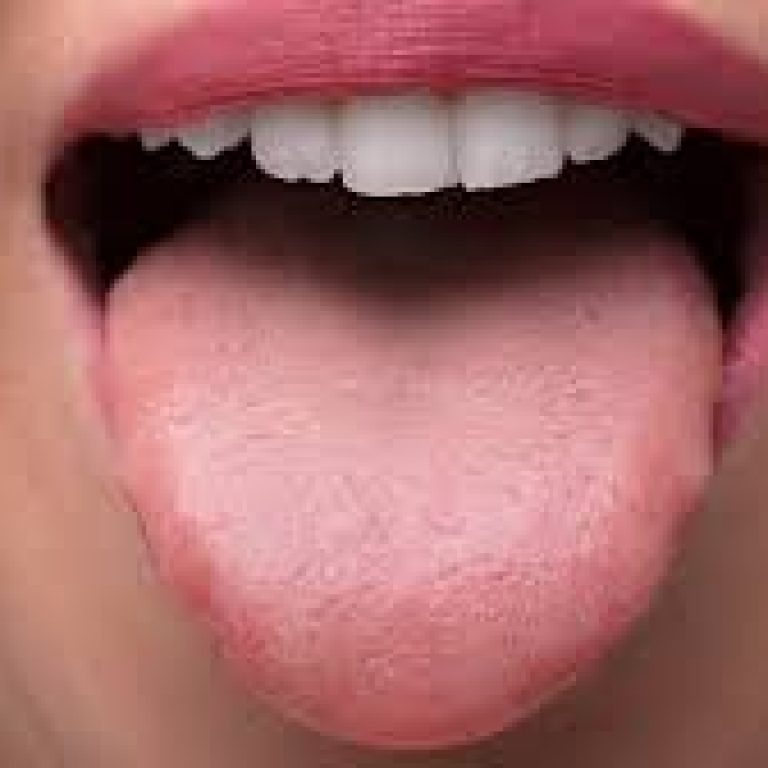 LA LEUCOPLASIA ORAL Y SU IMPLICACIÓN COMO LESIÓN PRECANCEROSA